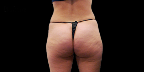 Lanluma Before